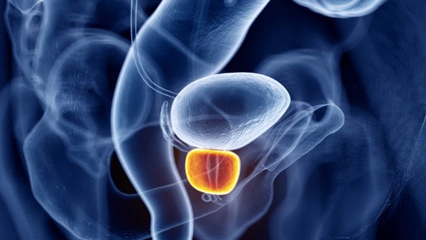 adenocarcinoma prostata grado 4