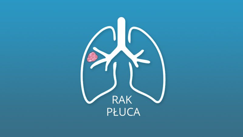 rak płuca – ilustracja poglądowa 