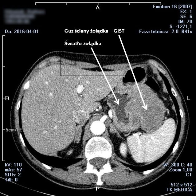 GIST żołądka w obrazie TK (tomografia komputerowa)