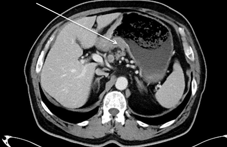 Rak żołądka w obrazie TK (tomografia komputerowa)