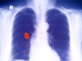 rak płuca – ilustracja poglądowa 