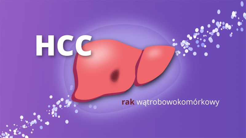 rak wątrobowokomórkowy (HCC) ilustracja poglądowa