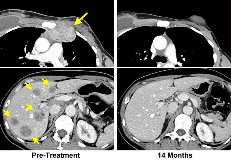 rak piersi wyniki leczenia immunoterapia po 14 miesiącach (NCI)