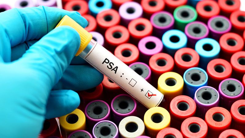PSA total (antigen specific prostatic)