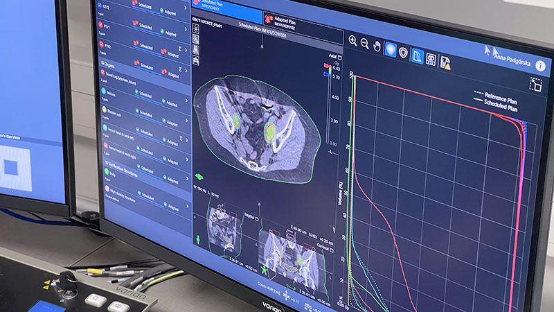 Zabieg radioterapii adaptacyjnej w Narodowym Instytucie Onkologii w Gliwicach
