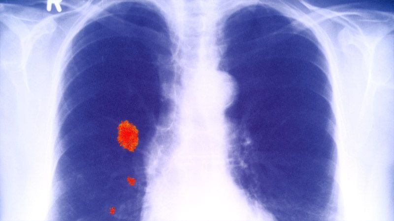rak płuca - grafika poglądowa
