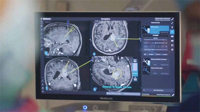 operacja guza mózgu metodą ablacji laserowej pod kontrolą rezonansu magnetycznego