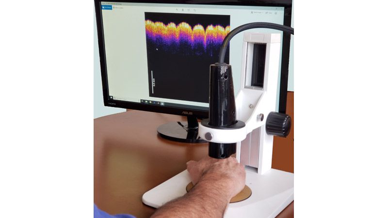 urządzenie do „wirtualnej biopsji” skóry metodą VOCT